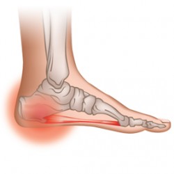 Calcaneal Spur