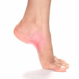 plantar fasciitis