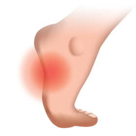 Foot Arch Pain