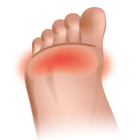 metatarsal pain