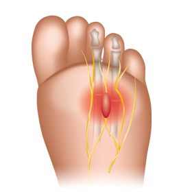 morton neuroma
