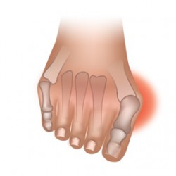 bunion treatment