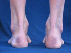 Supination