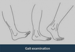 gait analysis
