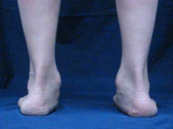 Pronation