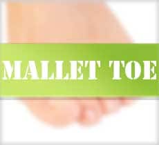 Mallet Toe