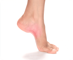 Plantar_Fasciitis-fs-blog