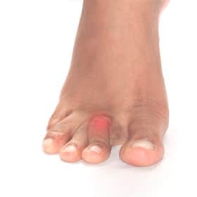 Hammertoe Foot Solutions