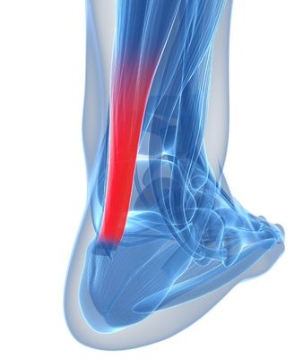 Achilles Tendonitis