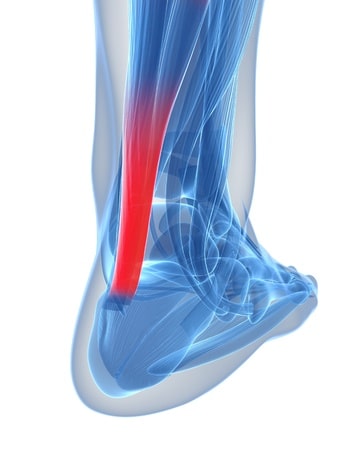 Achilles Tendonitis