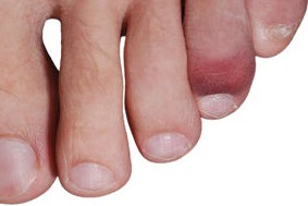 broken toe