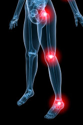 sciatica