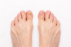 toe nail fungus 