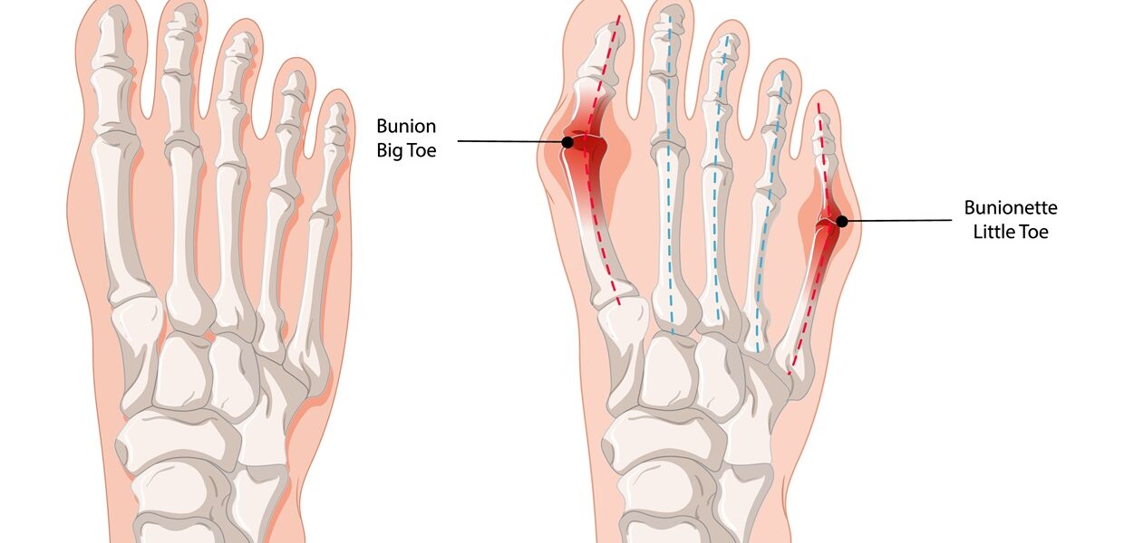 Bunions