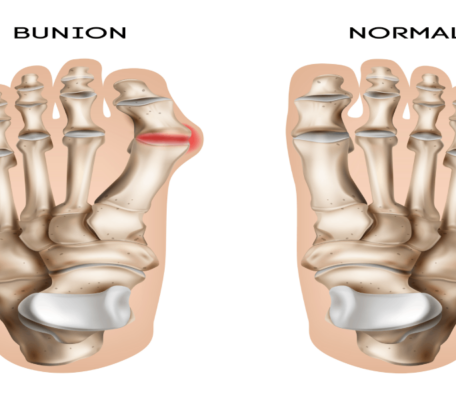 Bunions on the feet