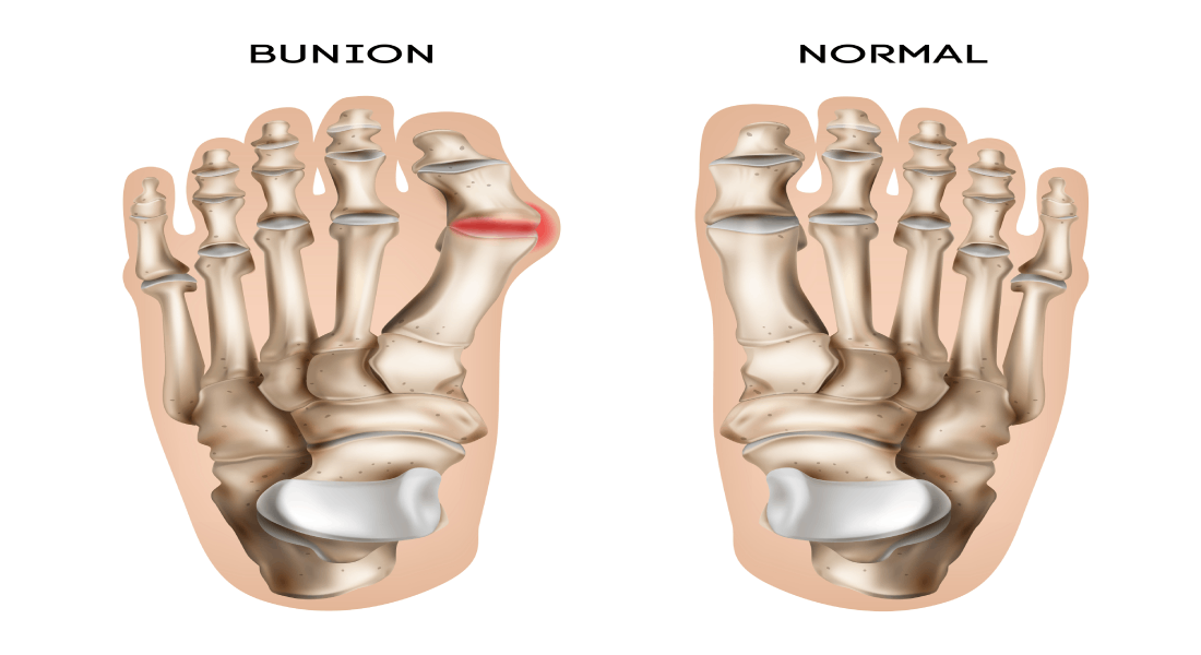 Bunions on the feet