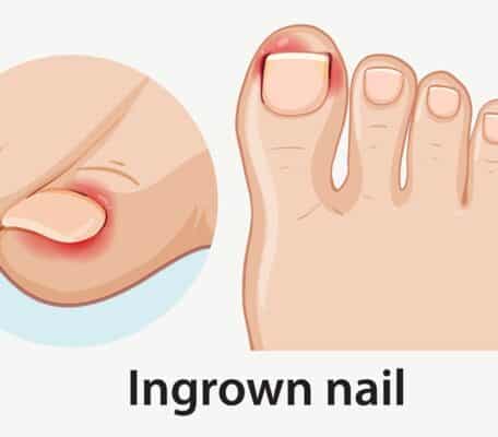 Ingrown Toenail