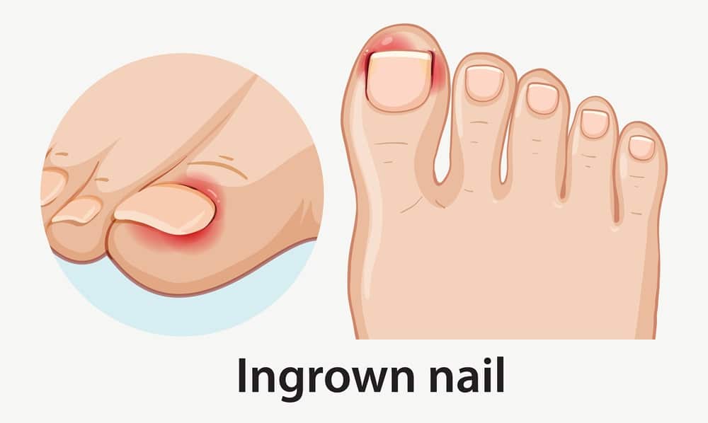 Ingrown Toenail